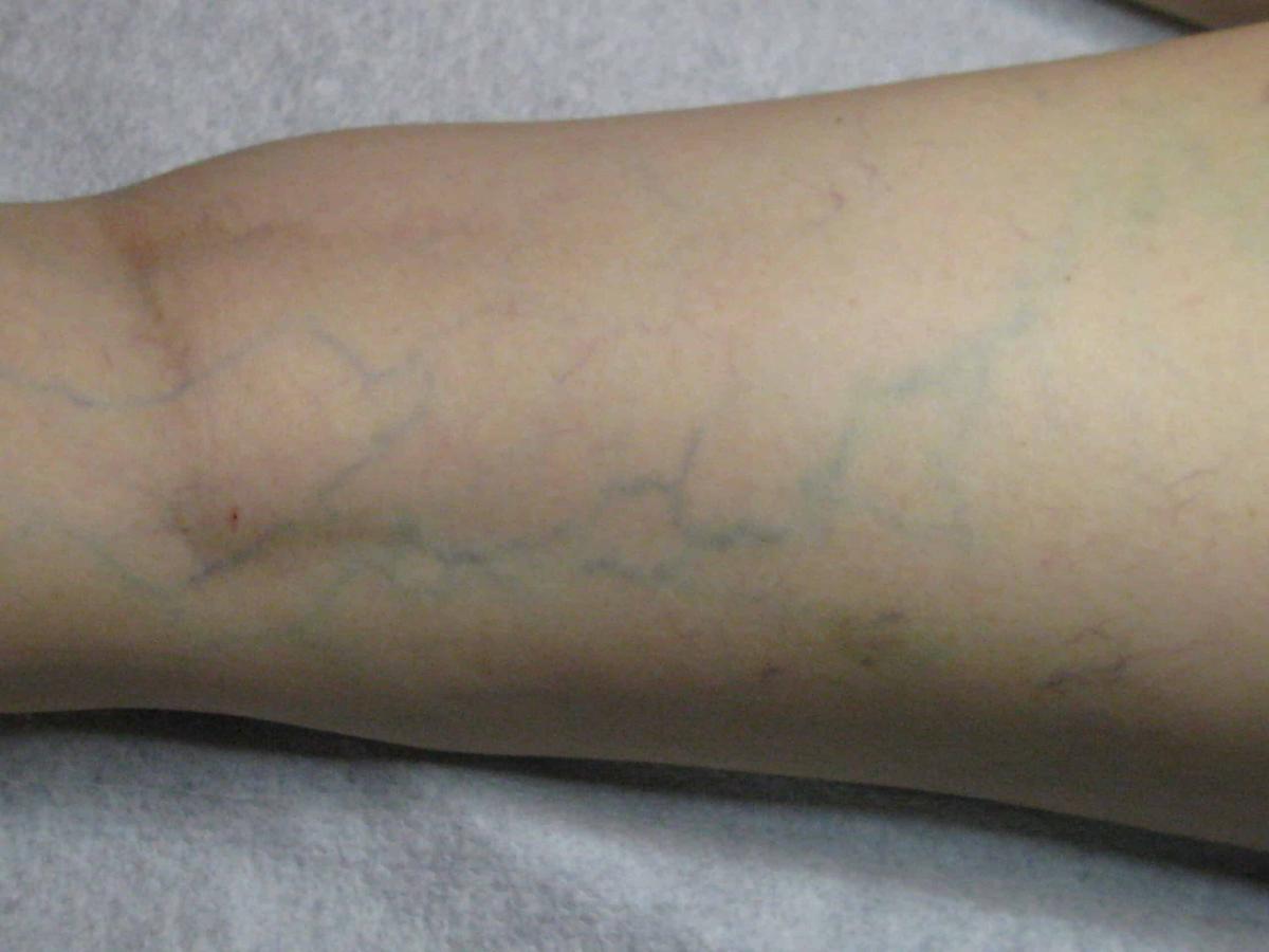 Αν δείτε κάποιον με διογκωμένες φλέβες, πρέπει να του πείτε αυτά τα πράγματα 1 img 3244 scaled