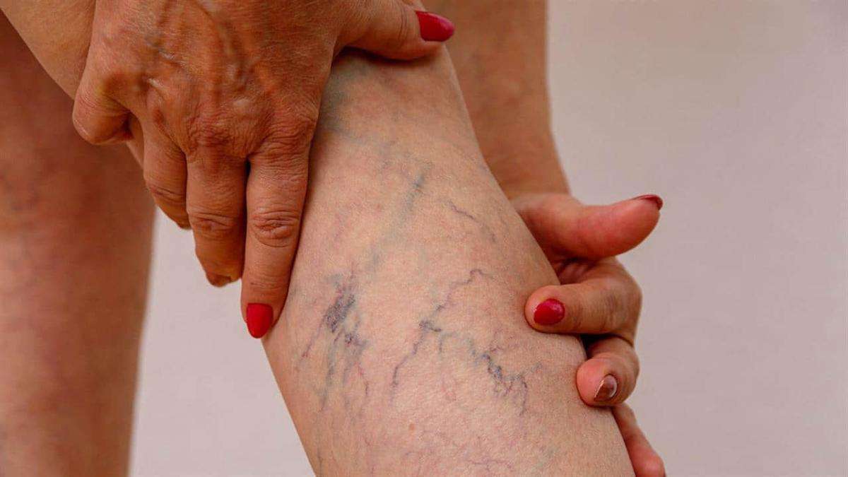 Αν δείτε κάποιον με διογκωμένες φλέβες, πρέπει να του πείτε αυτά τα πράγματα 3 123205 veins31280