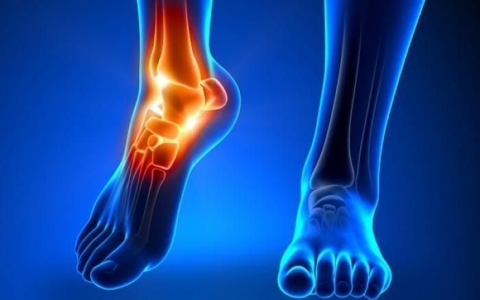 Το #1 ρόφημα για να αντιστρέψετε το υψηλό ουρικό οξύ και την ουρική αρθρίτιδα 1 oyrikharthritida