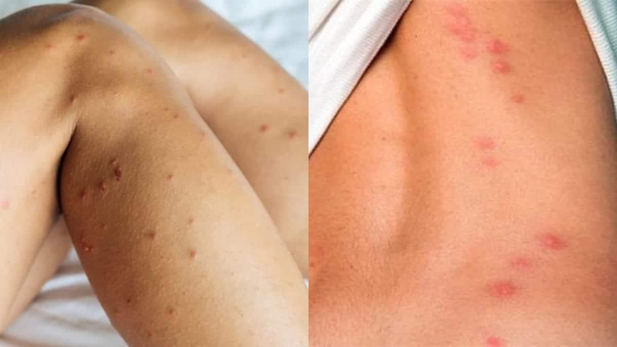 Ακάρεα, κοριοί, τσιμπούρια: Πως θα ξεχωρίσετε 9 διαφορετικά τσιμπήματα και τι πρέπει να κάνετε στο καθένα 1 akarea spyrakia