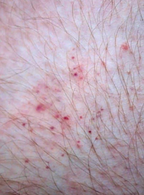 Ακάρεα, κοριοί, τσιμπούρια: Πως θα ξεχωρίσετε 9 διαφορετικά τσιμπήματα και τι πρέπει να κάνετε στο καθένα 3 τσιμπήματα από κοριό