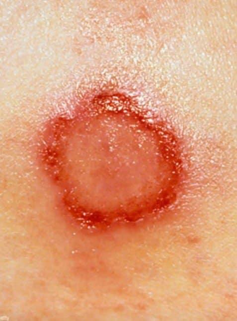 Ακάρεα, κοριοί, τσιμπούρια: Πως θα ξεχωρίσετε 9 διαφορετικά τσιμπήματα και τι πρέπει να κάνετε στο καθένα 4 20220501 626e4d3e37a01