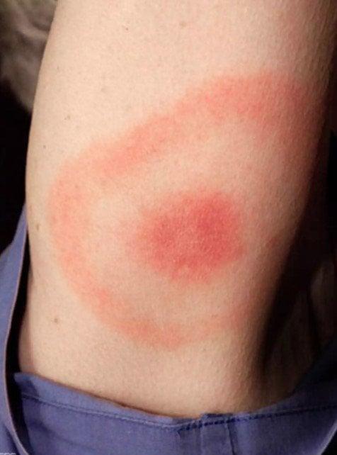 Ακάρεα, κοριοί, τσιμπούρια: Πως θα ξεχωρίσετε 9 διαφορετικά τσιμπήματα και τι πρέπει να κάνετε στο καθένα 5 20220501 626e4d3e3bf4e