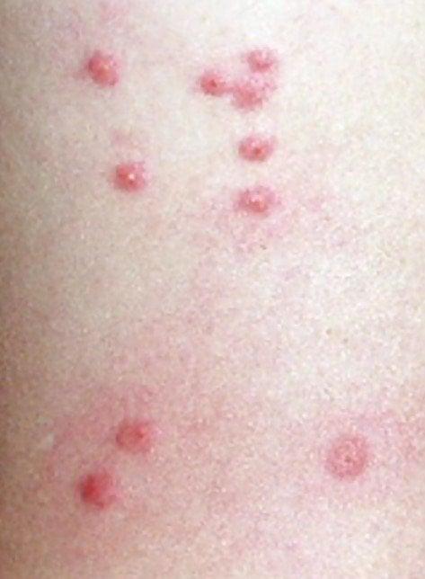 Ακάρεα, κοριοί, τσιμπούρια: Πως θα ξεχωρίσετε 9 διαφορετικά τσιμπήματα και τι πρέπει να κάνετε στο καθένα 6 20220501 626e4d3e4015a