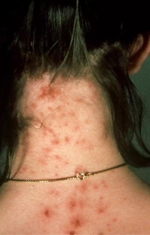 Ακάρεα, κοριοί, τσιμπούρια: Πως θα ξεχωρίσετε 9 διαφορετικά τσιμπήματα και τι πρέπει να κάνετε στο καθένα 8 20220501 626e4d3e453ce