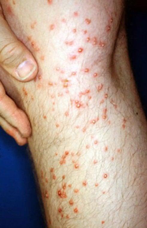 Ακάρεα, κοριοί, τσιμπούρια: Πως θα ξεχωρίσετε 9 διαφορετικά τσιμπήματα και τι πρέπει να κάνετε στο καθένα 9 20220501 626e4d3e47bb3