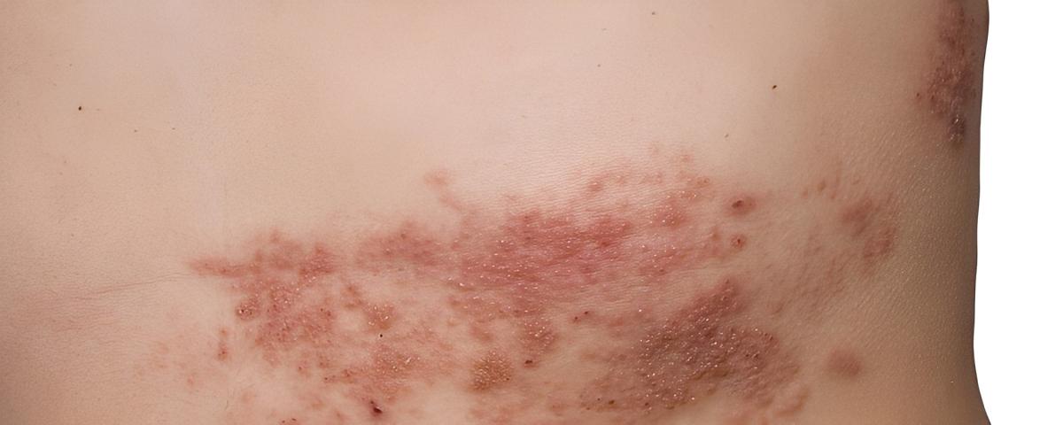 Όλα όσα πρέπει να γνωρίζετε για τα έρπητα ζωστήρα: Aιτίες, έγκαιρη ανίχνευση και φυσικές θεραπείες 1 444 6