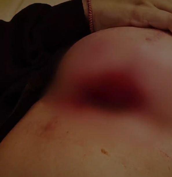 30χρονη Ελληνίδα μητέρα πήγε σε πασίγνωστο πλαστικό στην Αθήνα να φτιάξει το στήθος της και της το έκανε τετράγωνο 2 sth8os.jpg