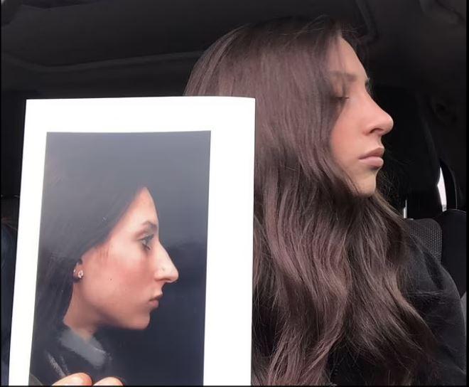 πλαστική στη μύτη