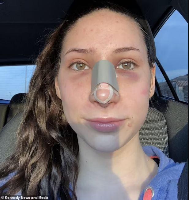 πλαστική στη μύτη