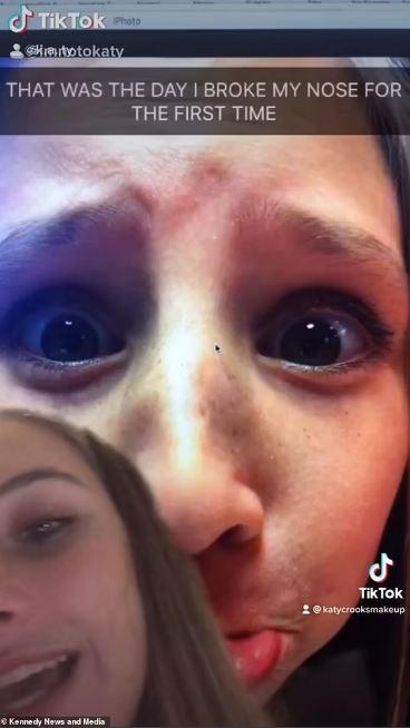 πλαστική στη μύτη