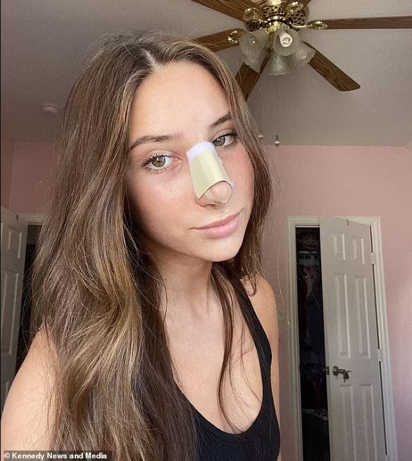 πλαστική στη μύτη