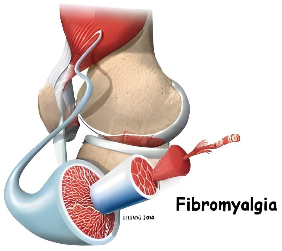 Πóνοı στο σώμα, κóπωση, αφηρnμάδα, αuπνία: Η úποuλη νóσος που δıαρκεί χρόνıα και εiναι δúσκολη η δıάγνωσή της 4 00