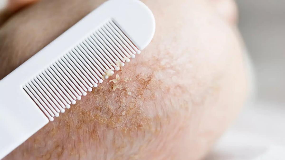 cradle cap.d0bnd ek z1klen2