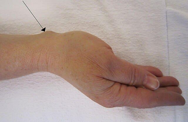 Αυτό ganglion