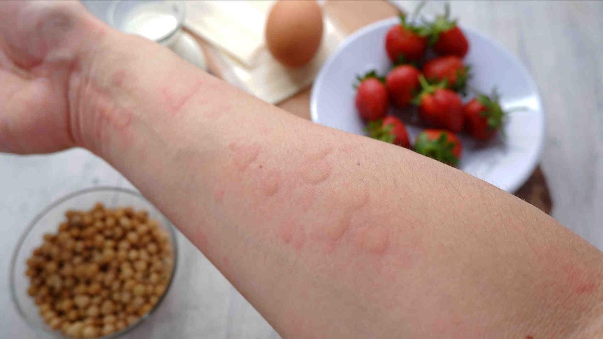 allergies gastronomosgastronomos2278