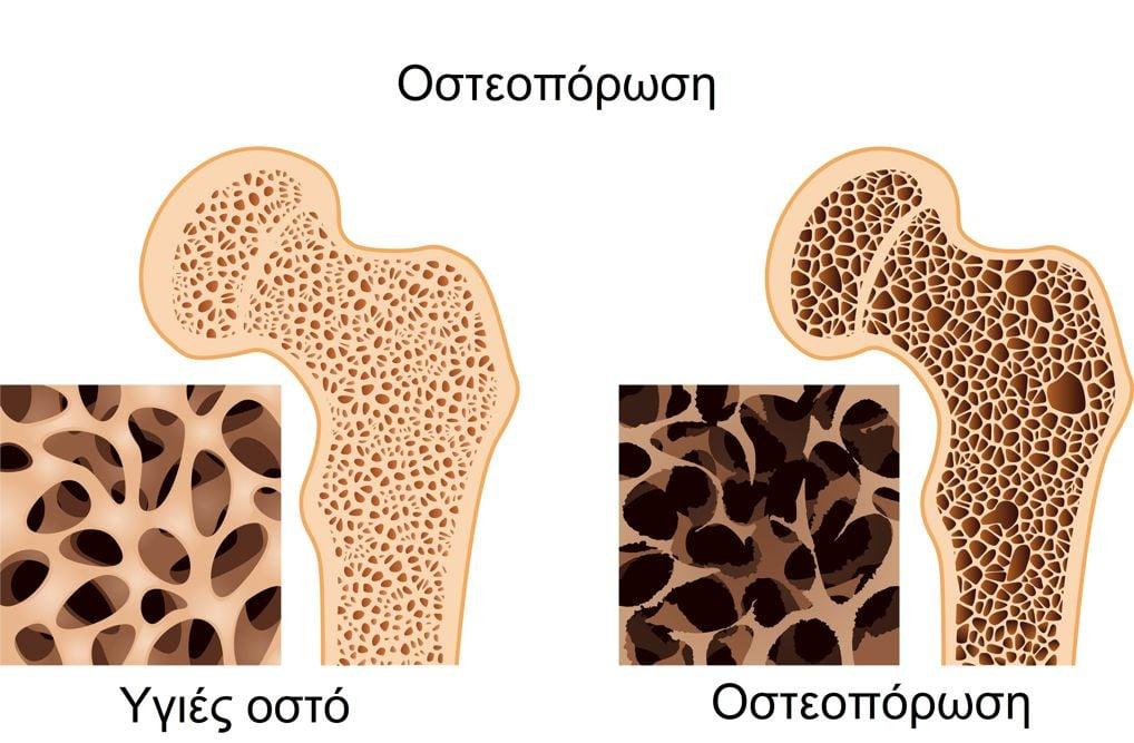 osteoporosi symptomata