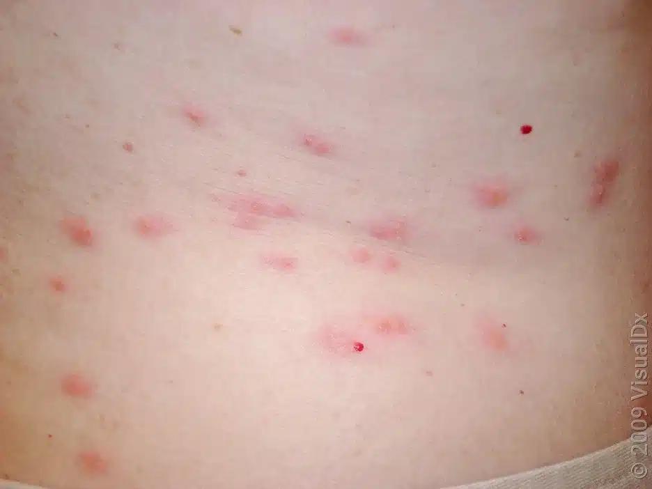 bed bug bites treatment 4283343
