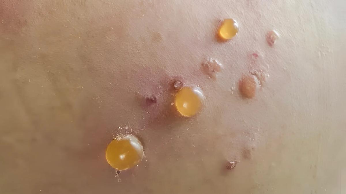 Τα δάχτυλα του συζύγου είναι καλυμμένα με αυτές τις μικροσκοπικές φουσκάλες νερού. Δεν μπορεί καν να πληκτρολογήσει για τη δουλειά 2 bullous pemphigoid.d8qvsec4 z2g83wa