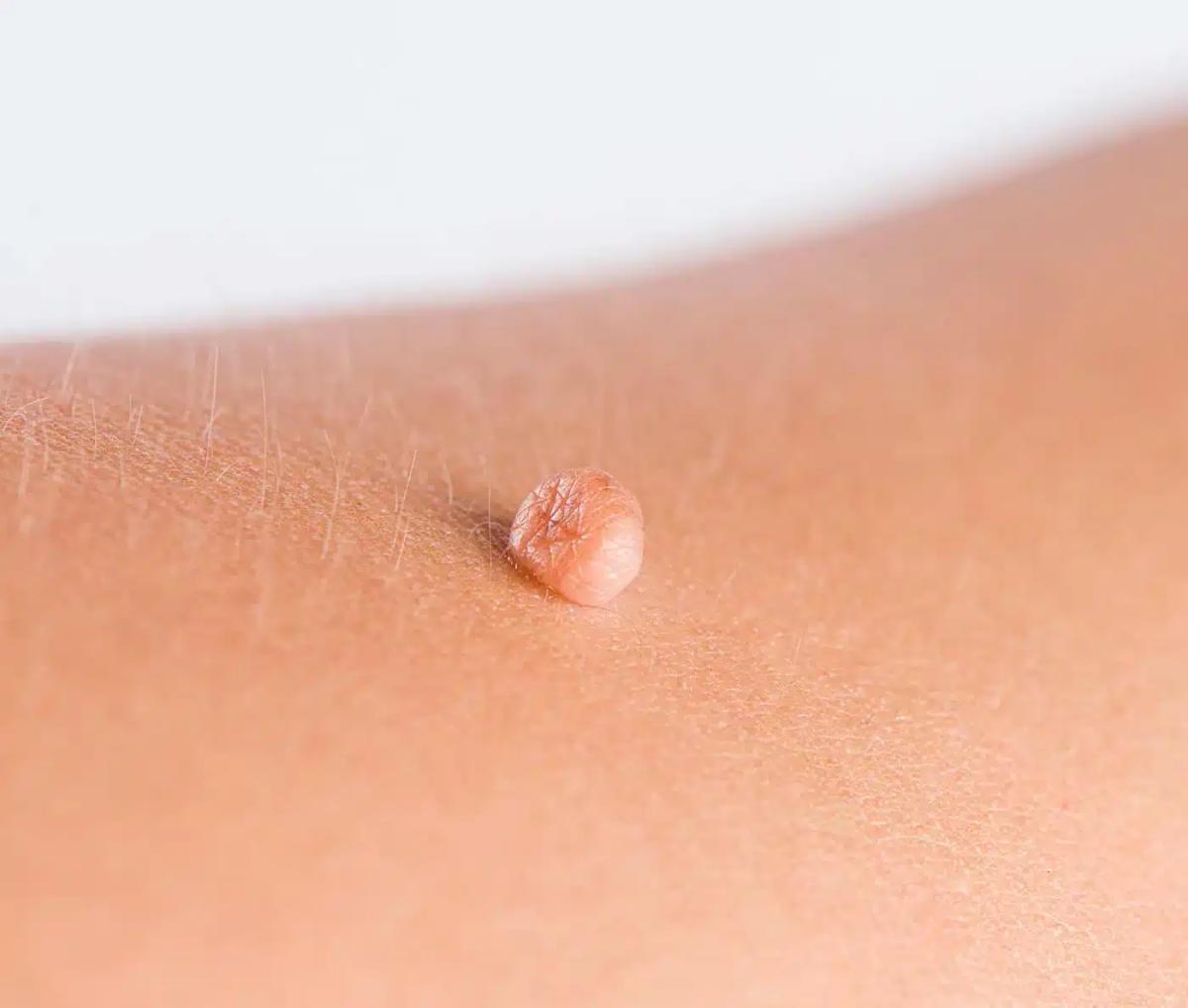 traitement excroissance peau skin marceau paris.jpg