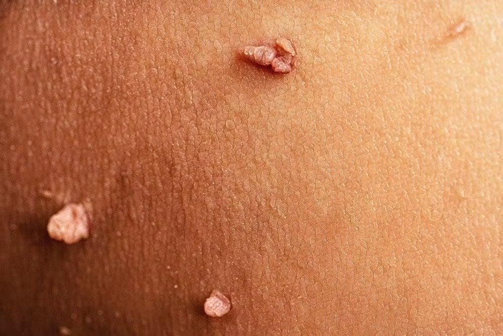 1731688818 apd genital warts symptoms 11zon