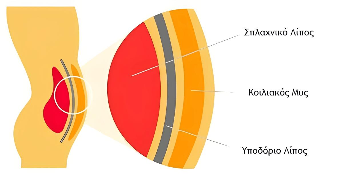 Σπλαχνικό λίπος: Οι υδατάνθρακες που αξίζει να βάλετε στο πιάτο σας 1 31