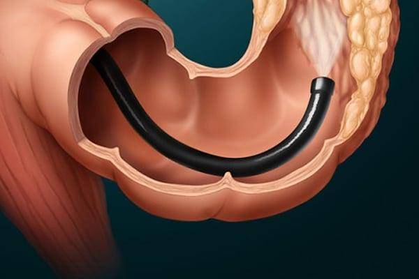 Κολονοσκόπηση: 4 πράγματα που είναι καλό γνωρίζουμε πριν την εξέταση 1 add2