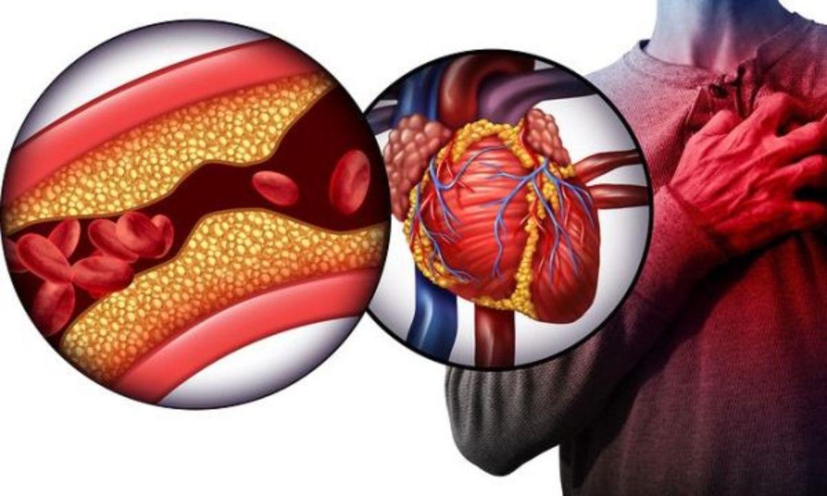 Ένα Holter ρυθμού για 48 ώρες έδωσε την απάντηση που αναζητούσε: κολποκοιλιακός αποκλεισμός δευτέρου βαθμού τύπου 1