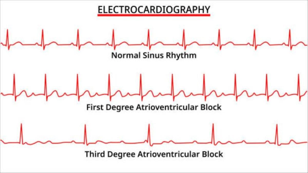 Καρδιακή πάθηση κατά την οποία οι ηλεκτρικοί παλμοί της καρδιάς καθυστερούν ή μπλοκάρονται