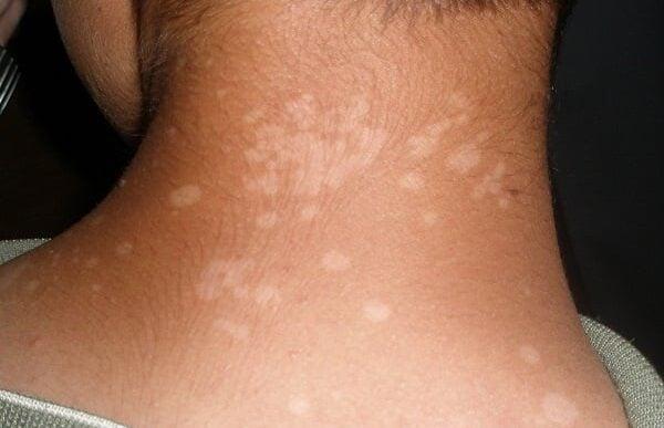 poikiloxrous3 600x387 1