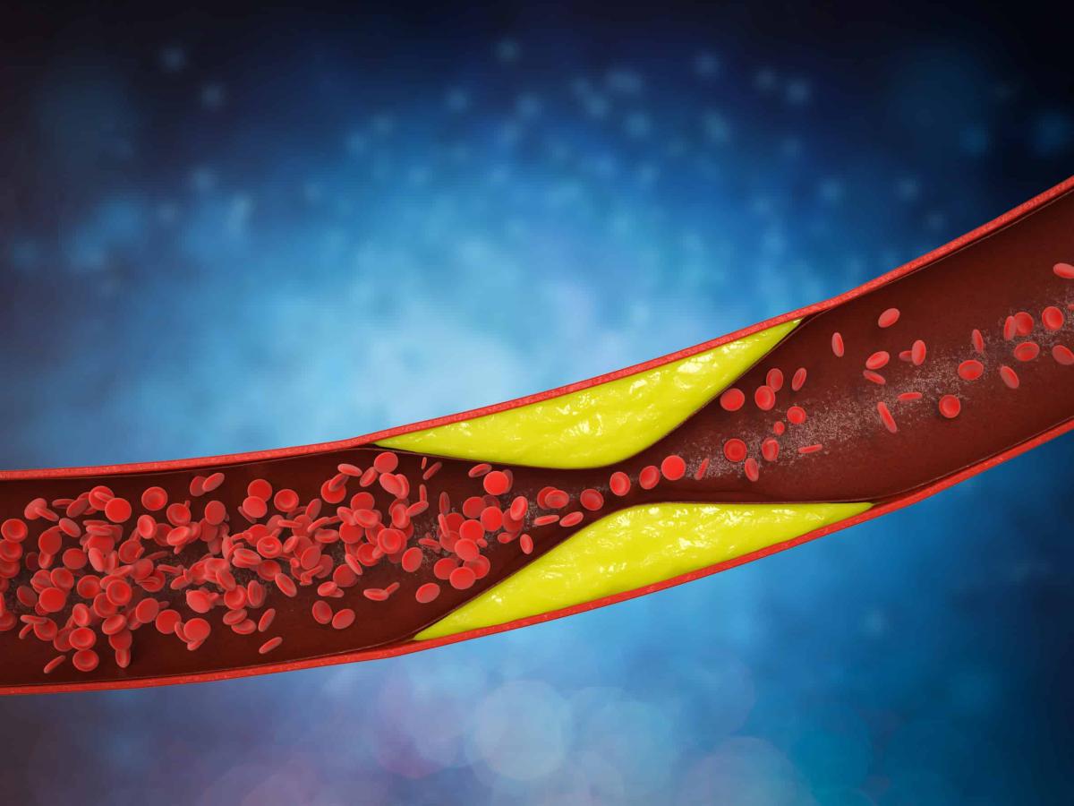 Καρδιολόγος: Η απλή καθημερινή συνήθεια που βοηθά τις αρτηρίες να μένουν καθαρές 3 fragmenes artiries symptomata antimetopisi