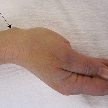 ganglion