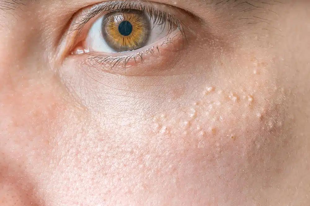 what is milia and how to handle milia