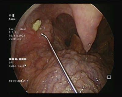 amygdalolithos amygdalolios tonsil stones orl plioytas 400x320 1