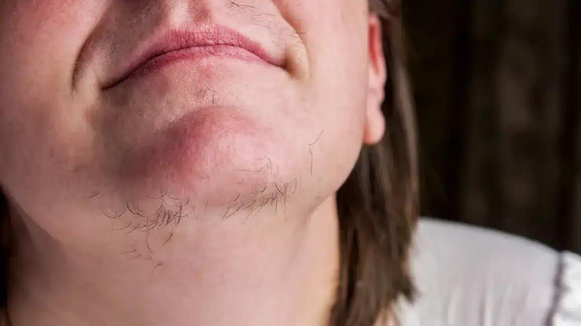 hirsutism of the chin body4