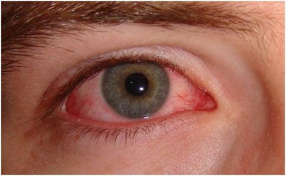 pinkeye