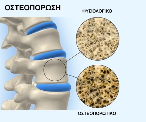 Οστεοπόρωση: Σωστή διατροφή – Οι τροφές που κάνουν τα οστά πιο δυνατά χωρίς κόπο 2 osteoporosis2