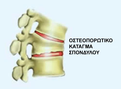 Οστεοπόρωση: Σωστή διατροφή – Οι τροφές που κάνουν τα οστά πιο δυνατά χωρίς κόπο 3 osteoporotic fracture1