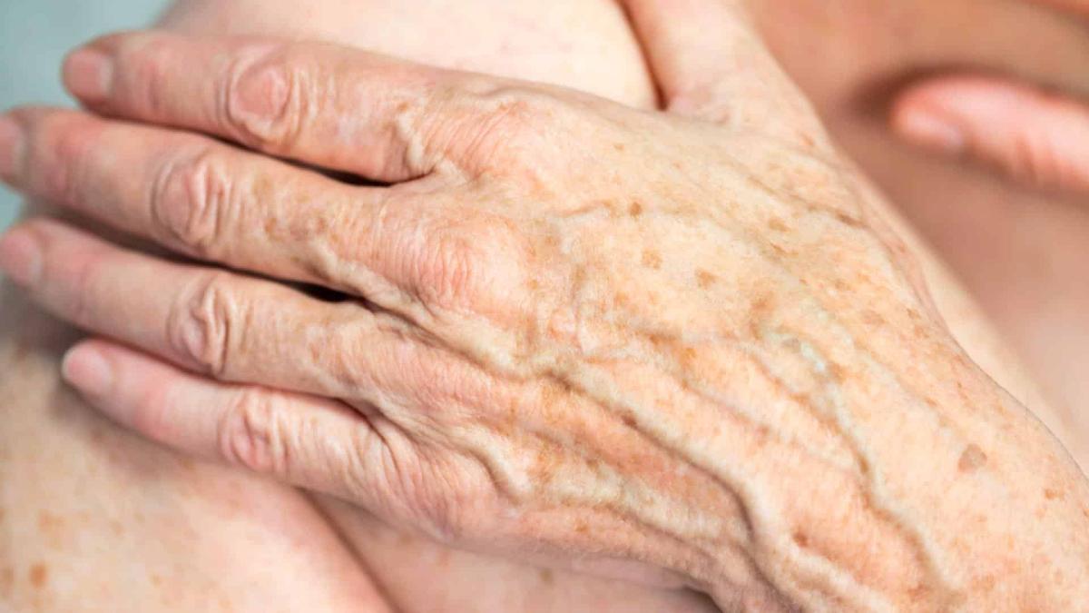age spots hands