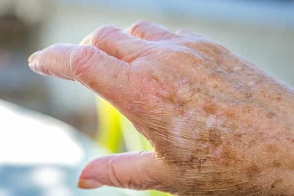 age spots