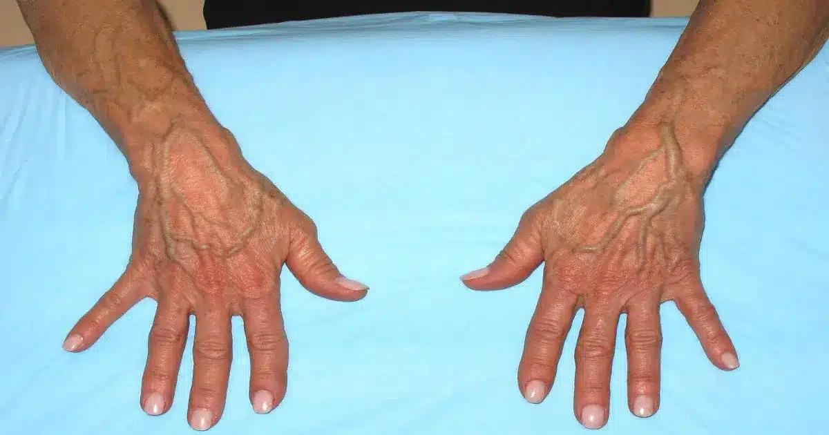 bulging veins in hands