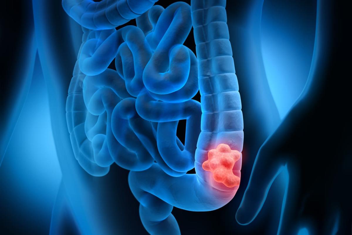 rectal bleeding crc 1500