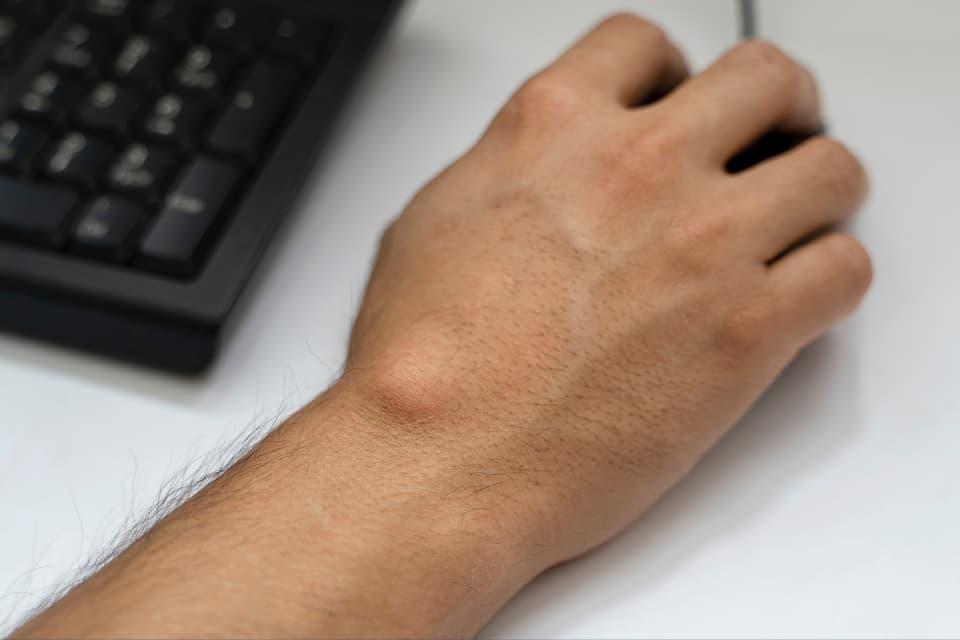 understanding ganglion cysts