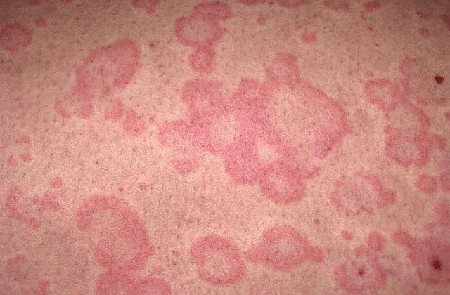 hives
