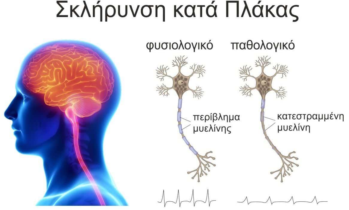 Σκλήρυνση κατά πλάκας (ΣΚΠ): Αuτά είναι τα Πρώιμα συμπτώματα 1 sklirynsi kata plakas neyra